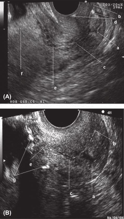 A Mid Sagittal Transvaginal Ultrasound Image At Weeks Gestation