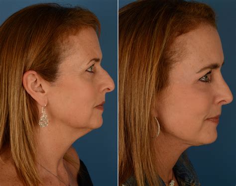 The Uplift Lower Face And Neck Lift Photos Naples Fl Patient 14192