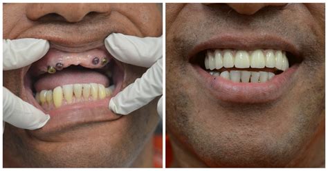 How Much For New Teeth Implants Teethwalls