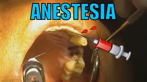 Anestesia Dental Hd Viyoutube