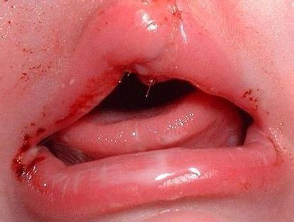 Causes of lip & mouth sores. What Causes a Fat Lip? | Health Advisor