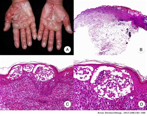 Clinicopathologic Variants Of Mycosis Fungoides Actas Dermo