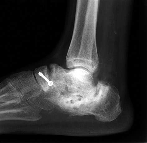 Symptomatic Nonunion After Fracture Of The Calcaneum Bone And Joint