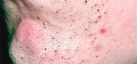 4 Common Skin Conditions Blackheads Whiteheads