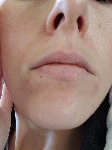 Skin Concerns Help With Red Spots Under Mouth And Around Nose