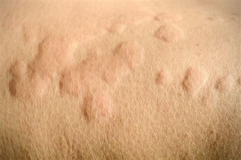 Cold Urticaria How Cold Temperatures Can Cause Hives The Healthy