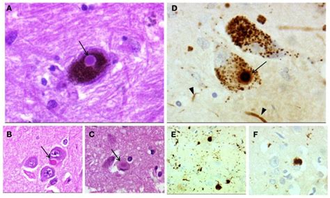Dementia With Lewy Bodies Neuropathology Lewy Body In A Neuron Of The