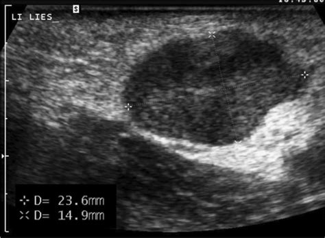 A Longitudinal Ultrasound Image Of The Left Groin A Year Old Girl Download Scientific