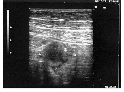 Acute Appendicitis Sonogram Close To The Right Lower Quadrant On