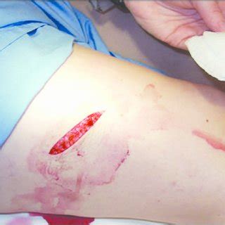 Example of a deep laceration with exposed subcutaneous tissue ...