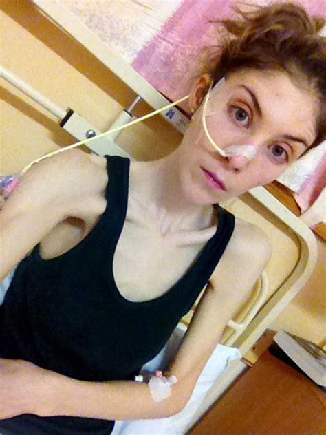 Amazing Transformation Of Anorexic Student Was Hours From Death After