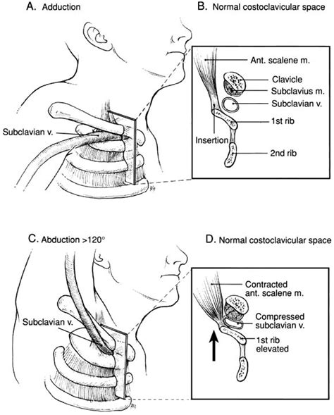 Surgical Management Of Subclavian Vein Effort Thrombosis As A Result Of