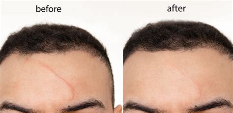 10 Things To Know Before Getting Laser Treatment For Your Scar Skinvolution