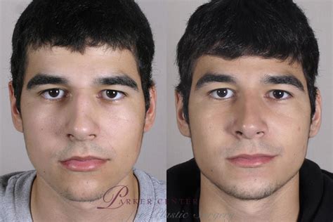 Rhinoplasty Before And After Pictures Case 152 Paramus Nj Parker