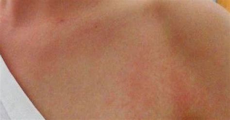 Heat Rash The Causes Preventions Treatments Along With How To Ease