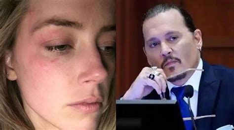 Amber Heards Attorneys Release Photos Of Her Bruised Face After Johnny Depp Hit Her With Phone