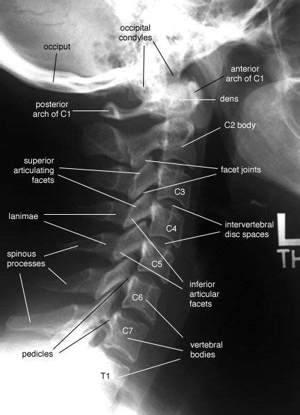 Cervical Spine Lateral View Radiology Student Medical Anatomy