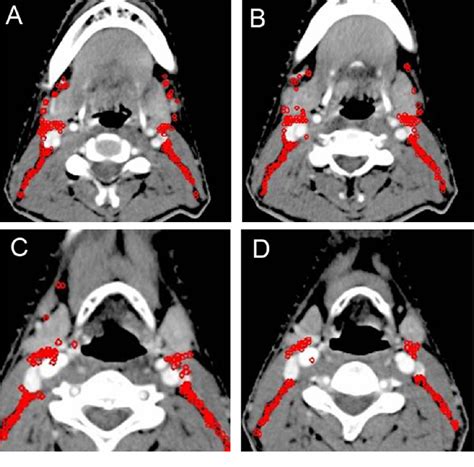 Figure 3 From Optimization Of Cervical Lymph Node Clinical Target