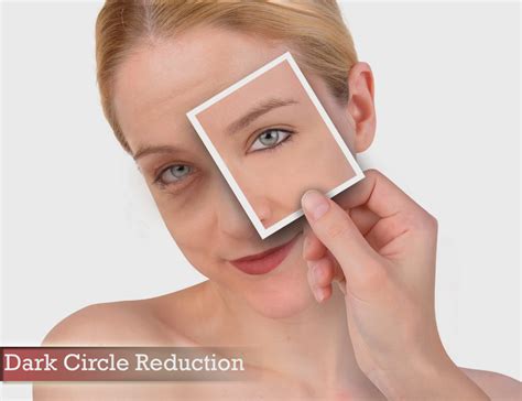 Dark Discoloration Of The Skin Under The Eye Is Mainly Referred To As