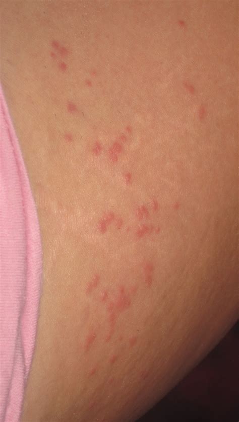 Itchy Red Bumps And Blisters On Skin Prnso