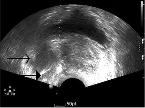 Transrectal Prostate Ultrasonographic Image Sagittal View The Download Scientific Diagram