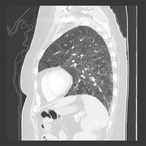 Pulmonary Veno Occlusive Disease Image