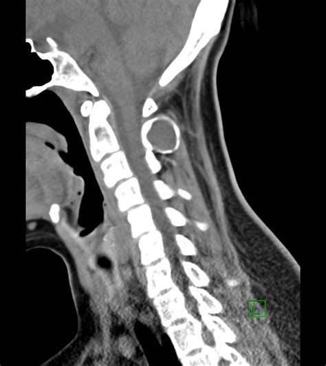 Aneurysmal Bone Cyst Cervical Spine Image Radiopaedia Org