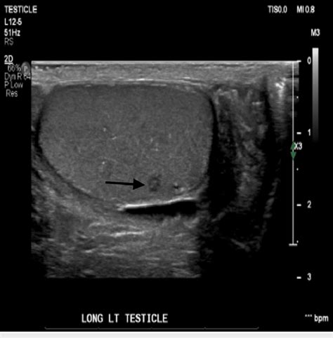 Scrotal Ultrasound Of The Left Testicle Longitudinal Axis Which Download Scientific Diagram