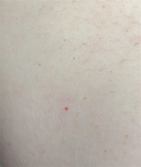 What Are These Little Red Dots On My Arms Rdermatology