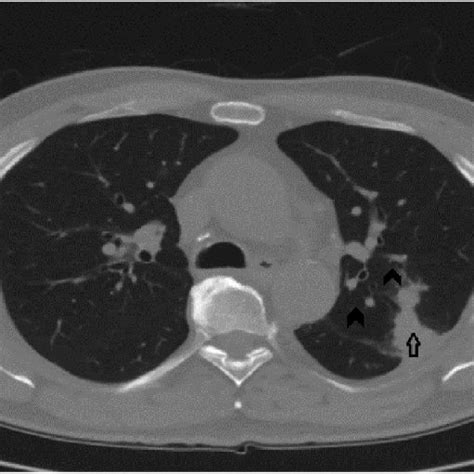 Initial Ct Scan Of The Chest Showing Left Lung Mass Arrow Nodules