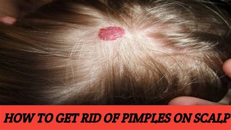How To Get Rid Of Scalp Pimples Ll How To Treat Pimples On Scalp Ll