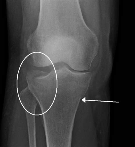 During an open reduction, orthopedic surgeons reposition your bone pieces during surgery to put them back into position. Crus fracture - Wikipedia