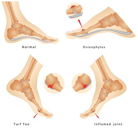 Turf toe injury is classically defined as damage resulting from hyperextension of the first mtp joint. What is Turf Toe? - Sterling Foot Doctor Shuman Podiatry ...