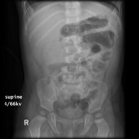 Normally most of the bowel contains fluid/faeces (light grey) and therefore is not visualised on the radiograph. The Abdominal XRay: A relic or a reliable tool? — Taming ...