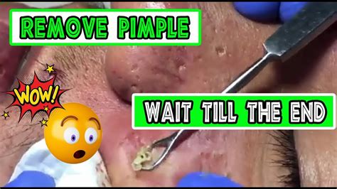 Amazing Big Pimple Removal How To Remove Blackhead Youtube
