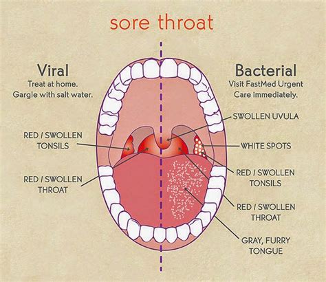 Discovering Joy And Wellness Difference Between Tonsillitis And Sore Throat