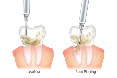 What Is Scale And Root Planing Implant Perio Center