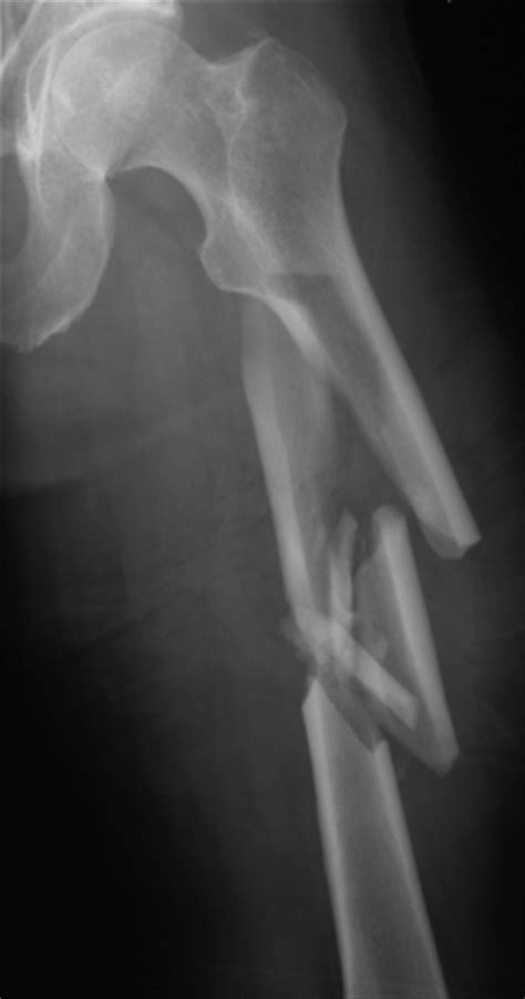 Broken Femur Xray