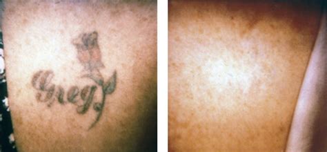 How to remove tattoo derm. Tattoo Removal | Winnipeg | The Derm Centre