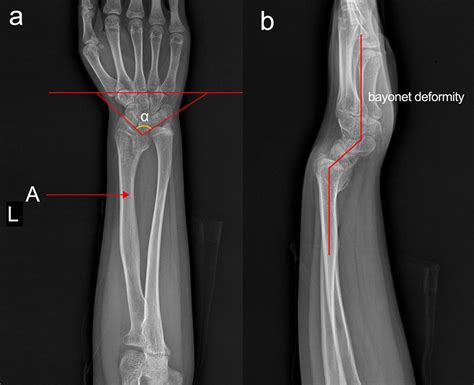 A Girl With Left Wrist Deformity The Bmj
