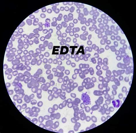 Hematology Case Study The Story Of The Platelet Clump Edta Induced