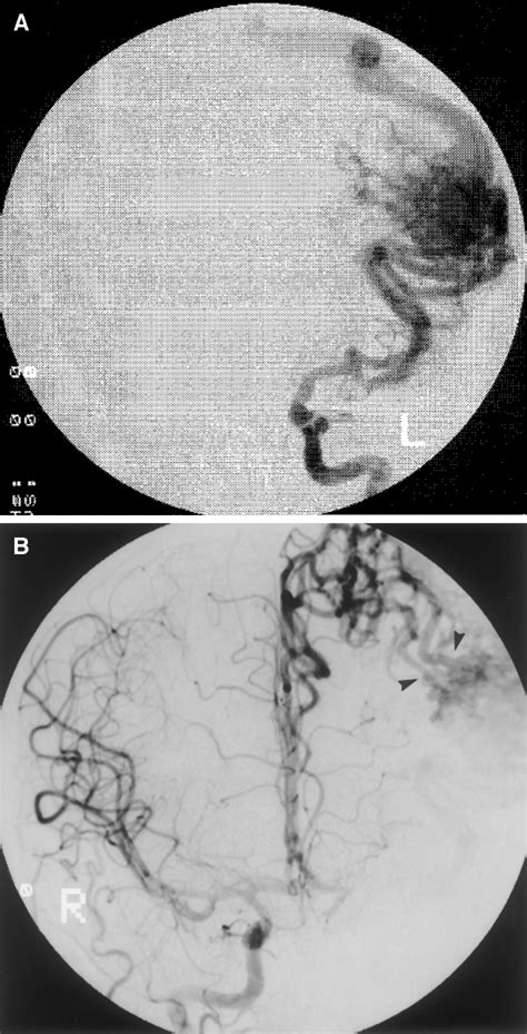 A Anteroposterior Ap View Of A Left Internal Carotid Arteriogram