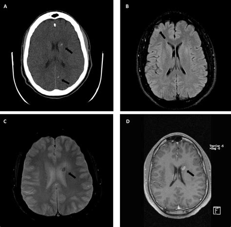 Neurocysticercosis A Contemporary Presentation Of The Neuroimaging