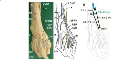 Gross Anatomy Of The Cephalic Vein And Superficial Branch Of The Radial