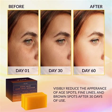 Valitic Kojic Acid Dark Spot Remover Soap Bars With Vitamin C Retinol