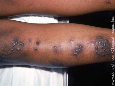 Nummular Eczema Symptoms And Causes National Eczema Association
