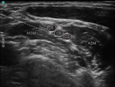Ultrasound Guided Axillary Brachial Plexus Nerve Block Nysora