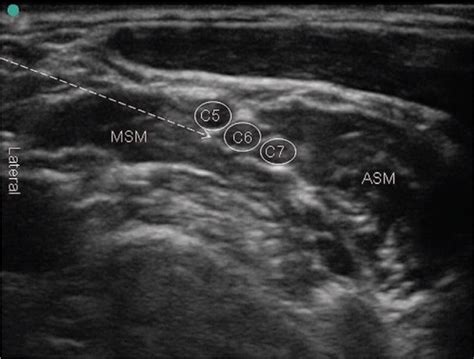 Sonographic View Of Interscalene Brachial Plexus Block With