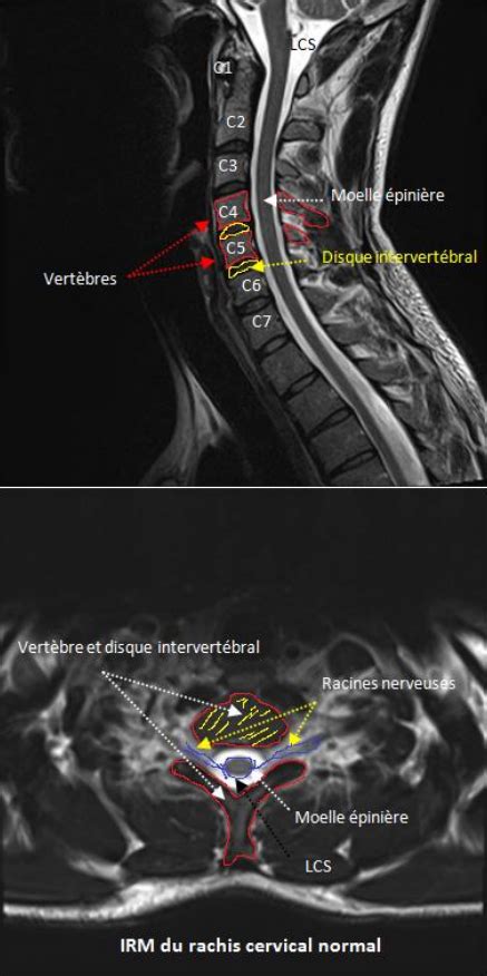 La hernie discale cervicale AÉSIO Santé