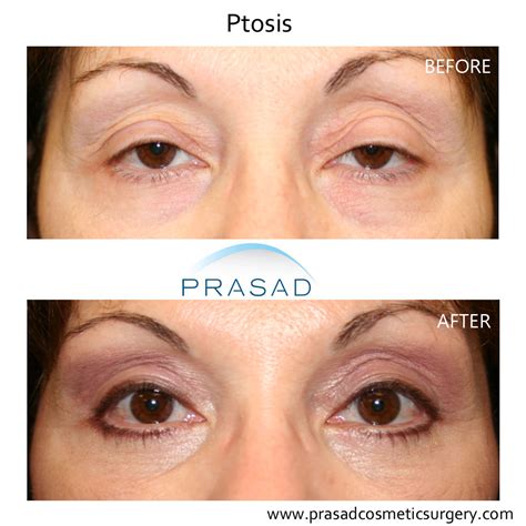 Ptosis Surgery Droopy Eyelid New York Specialist